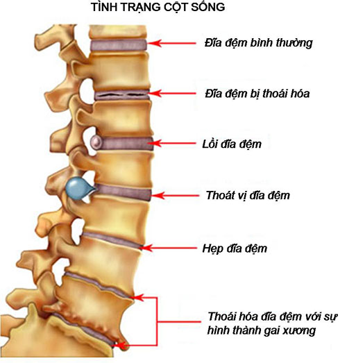 Thuốc Điều Trị Thoái Hóa Đốt Sống Lưng Của Úc: Giải Pháp Toàn Diện
