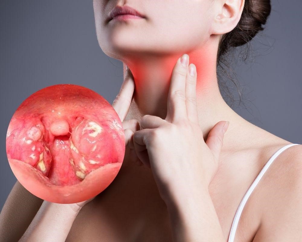 Viêm họng uống thuốc ngày thứ 3 vẫn chưa khỏi: Nguyên nhân và giải pháp Viêm họng uống thuốc ngày thứ 3 vẫn chưa khỏi: Nguyên nhân và giải pháp