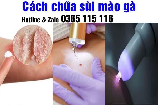 Uống Thuốc Gì Để Không Tái Phát Sùi Mào Gà: Giải Pháp Toàn Diện