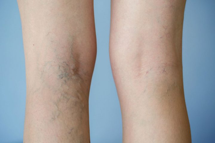 Tỏi Trị Giãn Tĩnh Mạch: Sự Thật Khoa Học & Cách Dùng An Toàn Tỏi Trị Giãn Tĩnh Mạch: Sự Thật Khoa Học & Cách Dùng An Toàn