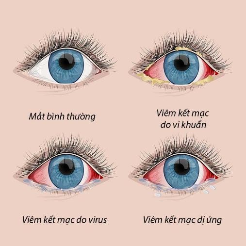 Thuốc Điều Trị Viêm Kết Mạc Dị Ứng Theo Mùa: Hướng Dẫn Toàn Diện