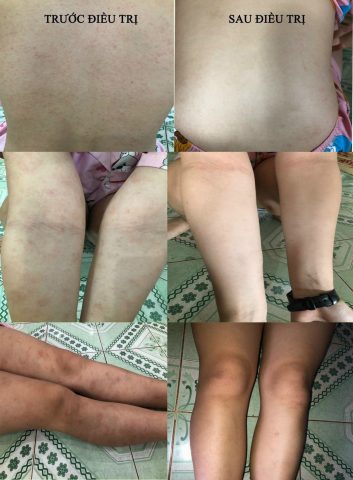 Thuốc trị giun sán và các tác dụng phụ thường gặp có thể gây ngứa