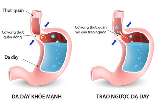 Bệnh Trào Ngược Bao Tử Buồn Nôn Uống Thuốc Gì? Giải Pháp Điều Trị Hiệu Quả