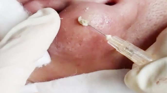Điều trị cận thị bằng thuốc bắc ở Gò Vấp: Thông tin tổng quan và lưu ý Điều trị cận thị bằng thuốc bắc ở Gò Vấp: Thông tin tổng quan và lưu ý