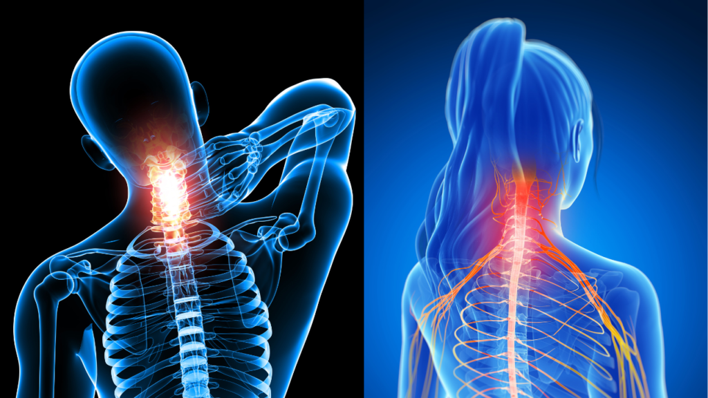 Bị Thoái Hóa Cột Sống Cổ Nên Uống Thuốc Gì: Hướng Dẫn Chi Tiết