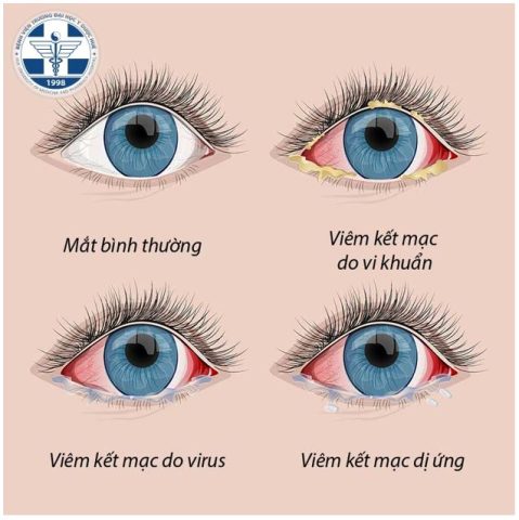 Thuốc Không Nên Dùng Cho Bệnh Viêm Kết Mạc: Hướng Dẫn Chi Tiết Từ Chuyên Gia