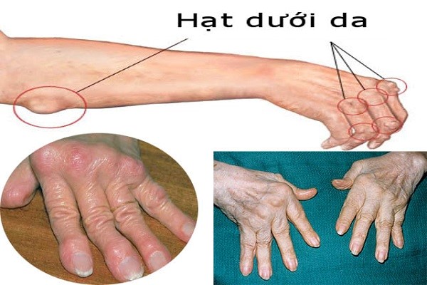 Bài Thuốc Dân Gian Chữa Viêm Đa Khớp Dạng Thấp Hiệu Quả Bài Thuốc Dân Gian Chữa Viêm Đa Khớp Dạng Thấp Hiệu Quả