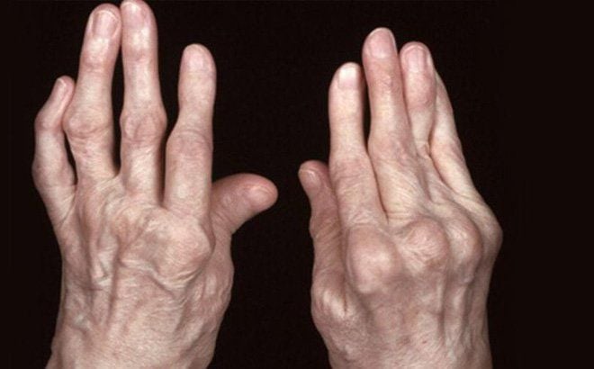 Bài Thuốc Dân Gian Chữa Viêm Đa Khớp Dạng Thấp Hiệu Quả Bài Thuốc Dân Gian Chữa Viêm Đa Khớp Dạng Thấp Hiệu Quả