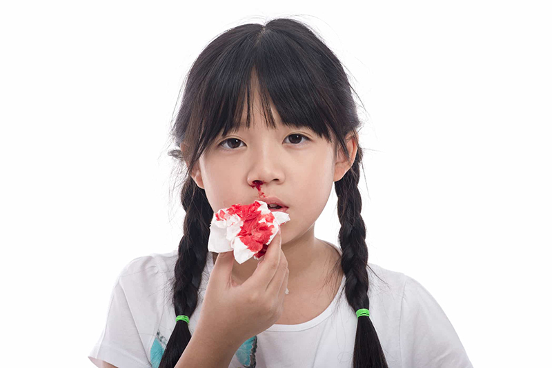 Chảy Máu Mũi Có Nguy Hiểm Không: Hiểu Rõ Nguyên Nhân và Cách Xử Lý