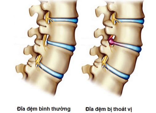 Nhà Thuốc Kầm Thiên Chuyên Trị Thoát Vị Đĩa Đệm: Đánh Giá Chi Tiết Nhà Thuốc Kầm Thiên Chuyên Trị Thoát Vị Đĩa Đệm: Đánh Giá Chi Tiết