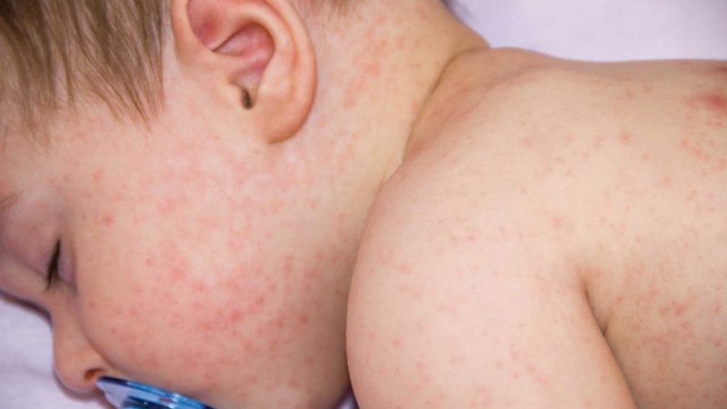 Uống Thuốc Dị Ứng Bao Lâu Thì Có Tác Dụng: Hướng Dẫn Chi Tiết