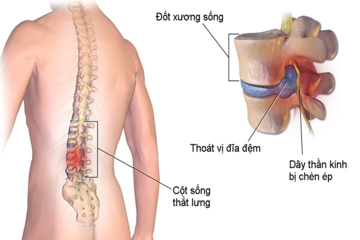 Hình ảnh cột sống bị thoái hóa cần được chăm sóc