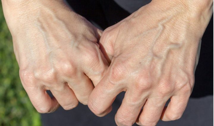 Nổi Gân Xanh: Nguyên Nhân, Dấu Hiệu và Giải Pháp Chăm Sóc Sức Khỏe