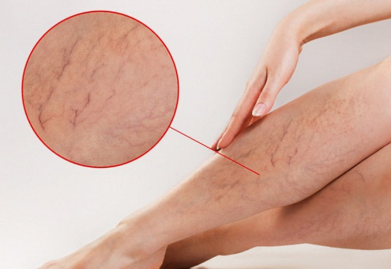 Dấu Hiệu Giãn Tĩnh Mạch: Nhận Biết Sớm Để Ngăn Ngừa Biến Chứng Nguy Hiểm