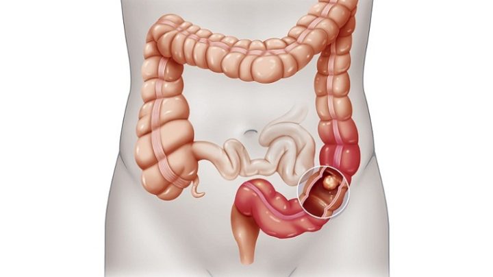 Điều Trị Ung Thư Đại Tràng Sigma: Các Phương Pháp Hiệu Quả Toàn Diện Điều Trị Ung Thư Đại Tràng Sigma: Các Phương Pháp Hiệu Quả Toàn Diện