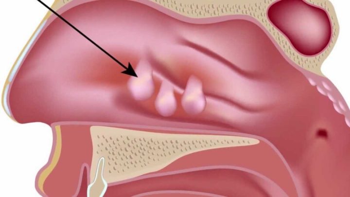 Cận cảnh polyp mũi qua nội soi