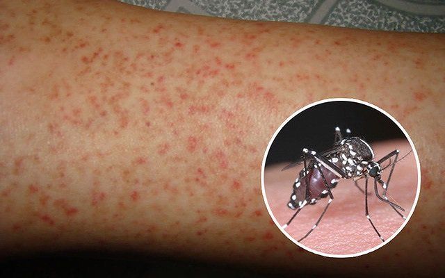 Y Lệnh Thuốc Dành Cho Người Sốt Xuất Huyết: Hướng Dẫn Chi Tiết