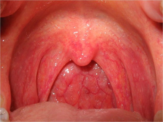 Cổ họng nổi gân máu: Nguyên nhân và cách điều trị hiệu quả