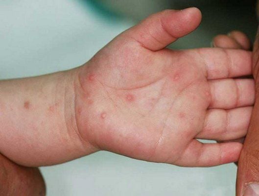 Thuốc Điều Trị Bệnh Chân Tay Miệng Ở Trẻ Em: Hướng Dẫn Chi Tiết