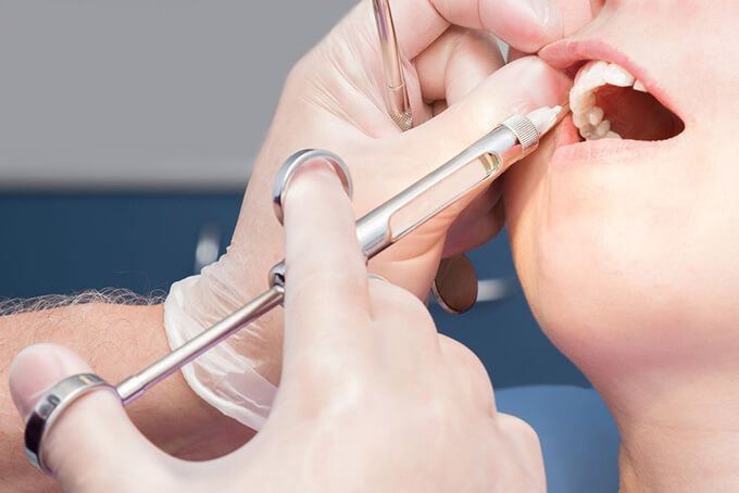 Tiêm Thuốc Tê Vào Răng Có Ảnh Hưởng Gì Không Và Giải Pháp An Toàn