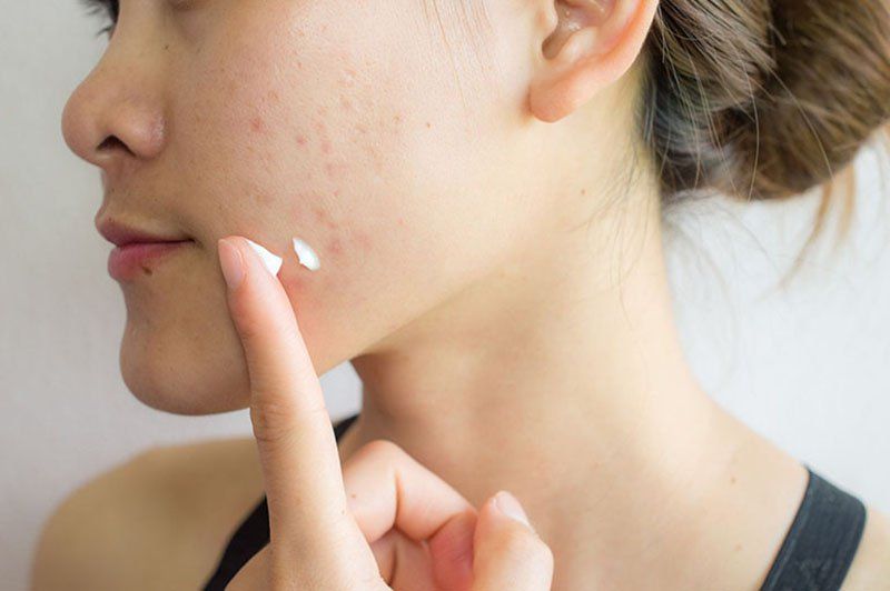 Bôi Thuốc Trị Mụn Lúc Mụn Như Thế Nào Là Đúng Cách Để Đạt Hiệu Quả Tối Ưu