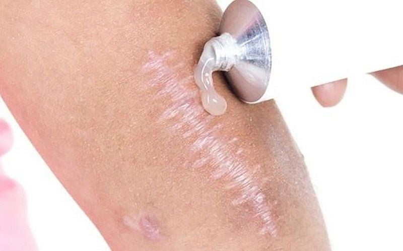 Lên Da Non Bôi Thuốc Gì Cho Mau Hết Đỏ: Hướng Dẫn Chi Tiết