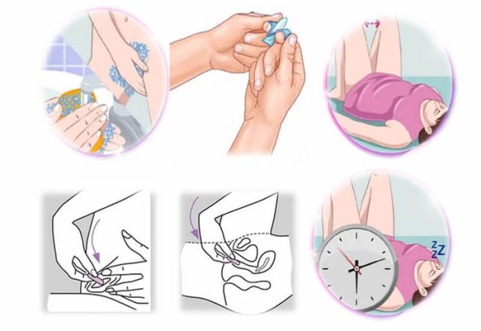 Đa dạng các dạng thuốc đặt âm đạo trên thị trường