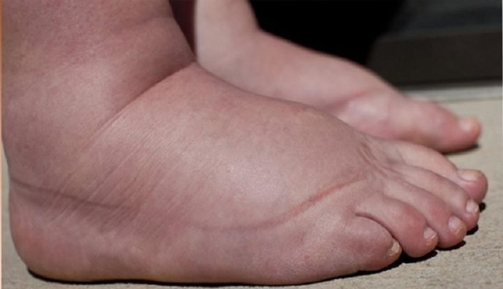 Nguyên nhân phù chân ở người già: Các vấn đề sức khỏe tiềm ẩn