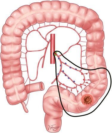 Điều Trị Ung Thư Đại Tràng Sigma: Các Phương Pháp Hiệu Quả Toàn Diện Điều Trị Ung Thư Đại Tràng Sigma: Các Phương Pháp Hiệu Quả Toàn Diện