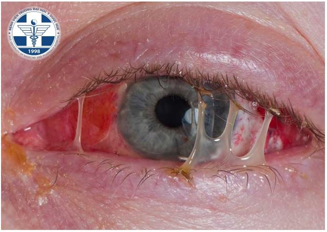 Thuốc Không Nên Dùng Cho Bệnh Viêm Kết Mạc: Hướng Dẫn Chi Tiết Từ Chuyên Gia
