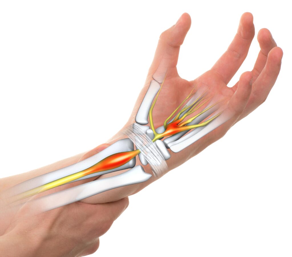 Bị Hội Chứng Ống Cổ Tay Nên Uống Thuốc Gì: Các Lựa Chọn Điều Trị