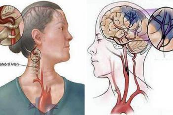 Thuốc Hỗ Trợ Điều Trị Tai Biến Mạch Máu Não: Tổng Quan Chuyên Sâu