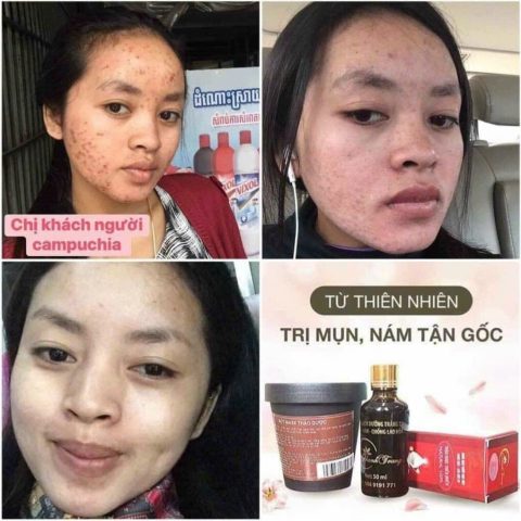 Thuốc Bắc Tái Tạo Da: Khám Phá Toàn Diện Về Phương Pháp Truyền Thống Và Rủi Ro Tiềm Ẩn