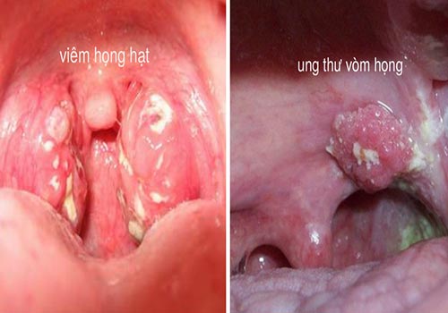 Hình ảnh một người đàn ông đau họng đang sử dụng thuốc xịt họng để giảm khó chịu