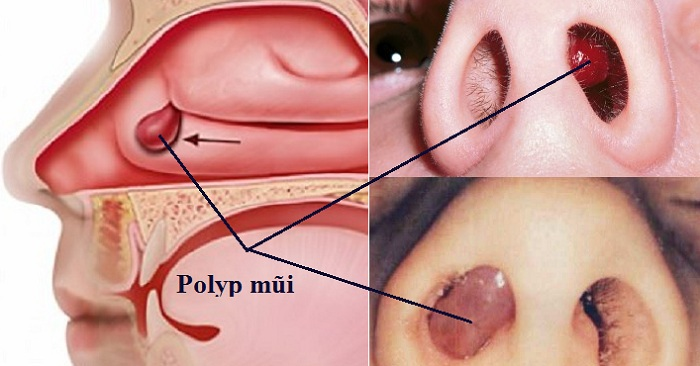 Polyp Mũi Có Nguy Hiểm Không: Giải Đáp Chi Tiết Từ Chuyên Gia