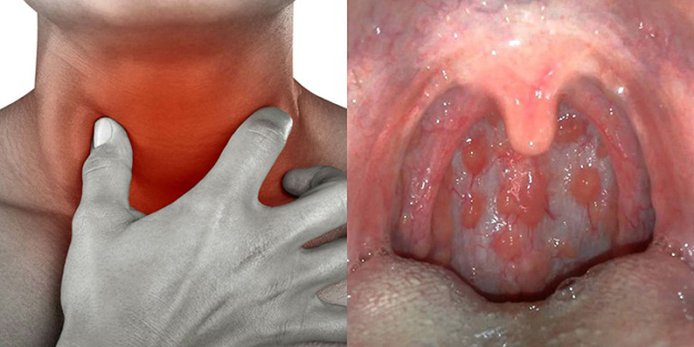 Viêm họng uống thuốc ngày thứ 3 vẫn chưa khỏi: Nguyên nhân và giải pháp Viêm họng uống thuốc ngày thứ 3 vẫn chưa khỏi: Nguyên nhân và giải pháp