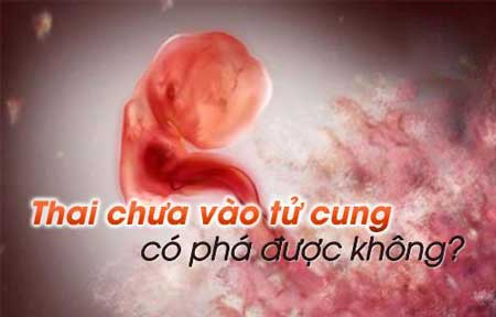 Thai Chưa Vào Tử Cung: Nguyên Nhân, Dấu Hiệu Và Cách Xử Lý Hiệu Quả