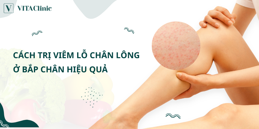 Thuốc Trị Viêm Lỗ Chân Lông Ở Chân Của Nhật: Giải Pháp Toàn Diện