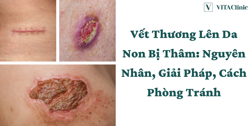 Lên Da Non Bôi Thuốc Gì Cho Mau Hết Đỏ: Hướng Dẫn Chi Tiết