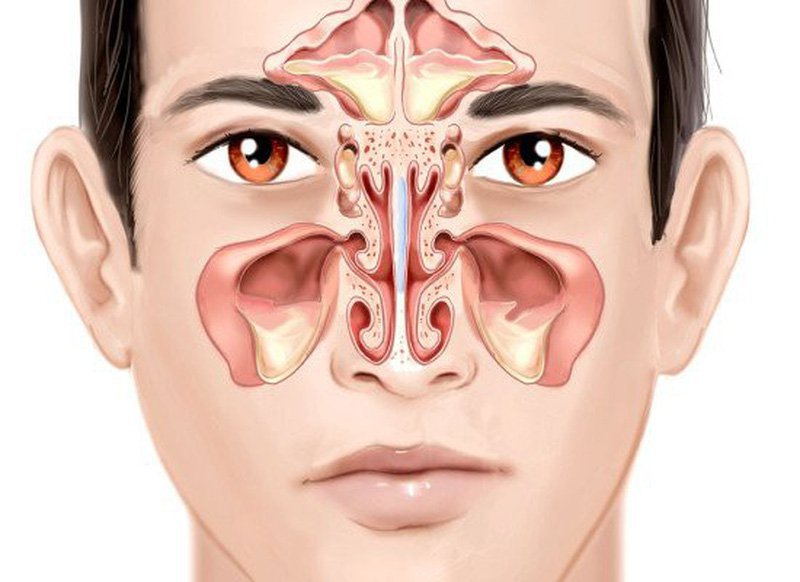 Nhỏ Tỏi Chữa Viêm Xoang: Hiệu Quả, Cách Dùng và Lưu Ý Quan Trọng