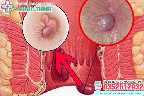 Các loại thảo dược tự nhiên giúp chữa bệnh trĩ tại nhà