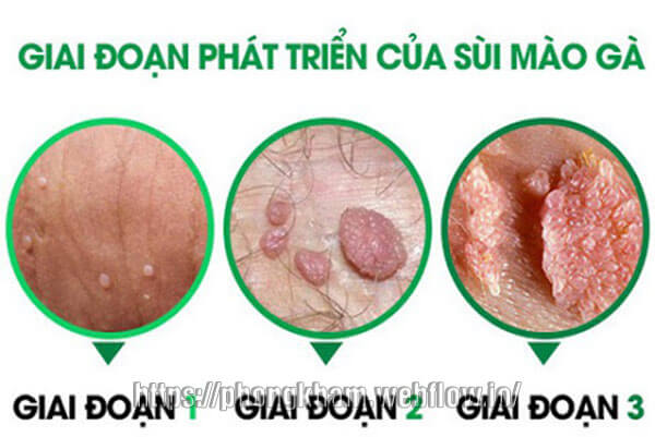 Điều trị sùi mào gà bằng thuốc Podophyllin hiệu quả: Hướng dẫn chi tiết