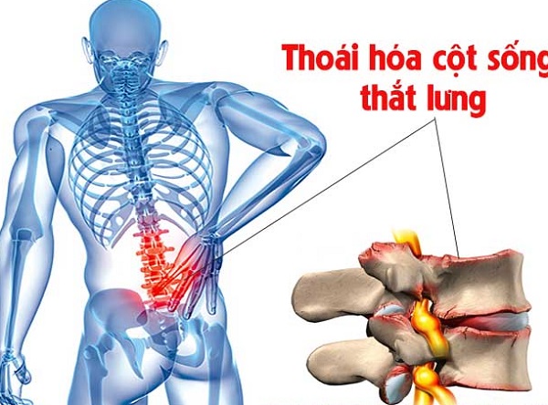 Thuốc Điều Trị Thoái Hóa Đốt Sống Lưng Của Úc: Giải Pháp Toàn Diện