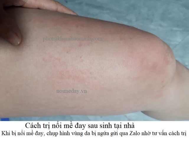 Điều Trị Nổi Mề Đay Sau Sinh: Phương Pháp An Toàn & Hiệu Quả Điều Trị Nổi Mề Đay Sau Sinh: Phương Pháp An Toàn & Hiệu Quả