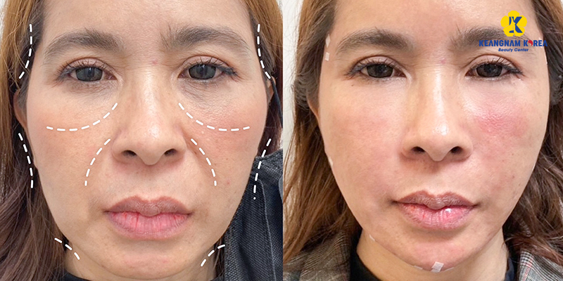Thuốc Tây Căng Da Mặt: Sự Thật & Lựa Chọn An Toàn Hiệu Quả