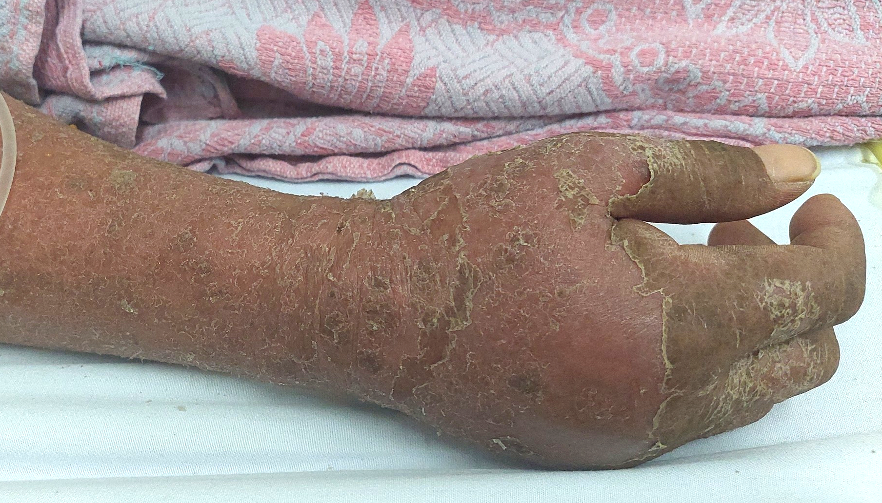 Vì sao bệnh nhân lao phải uống thuốc kéo dài: Giải đáp toàn diện Vì sao bệnh nhân lao phải uống thuốc kéo dài: Giải đáp toàn diện