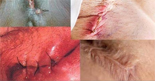 Thuốc Xử Lý Nhiễm Trùng Vết May Tầng Sinh Môn Hiệu Quả và An Toàn