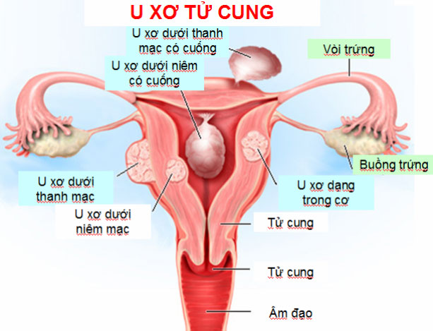 Điều trị đa nhân xơ tử cung bằng thuốc: Các phương pháp và lưu ý quan trọng