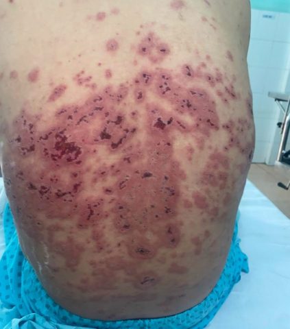 Bệnh Nhân Nằm Lâu Bị Lở Loét Bôi Thuốc Gì Hiệu Quả Nhất