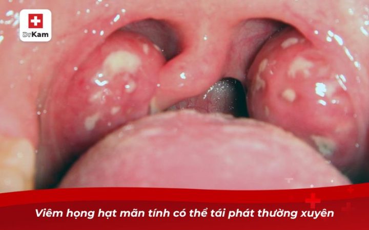 Bài Thuốc Dân Gian Chữa Viêm Họng Hạt Mãn Tính Hiệu Quả